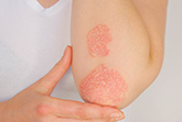 La vitamina D in aiuto ai pazienti con psoriasi