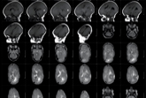 Amiselimod: nuova promessa nella cura della SM