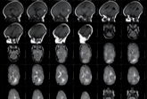 Amiselimod: nuova promessa nella cura della SM 